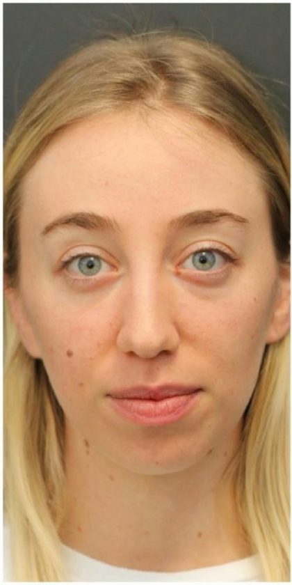 Aesthetic Facial Balancing Before & After Patient #1152
