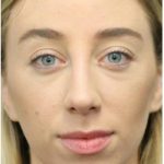 Aesthetic Facial Balancing Before & After Patient #1152
