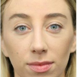 Aesthetic Facial Balancing Before & After Patient #1152