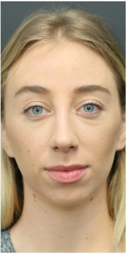Aesthetic Facial Balancing Before & After Patient #1152