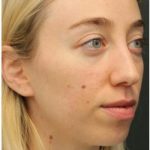 Aesthetic Facial Balancing Before & After Patient #1152