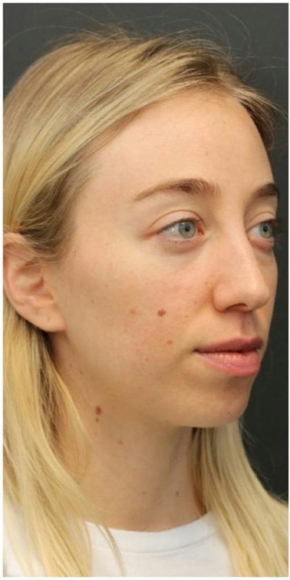 Aesthetic Facial Balancing Before & After Patient #1152