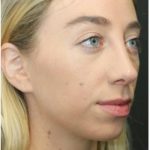 Aesthetic Facial Balancing Before & After Patient #1152