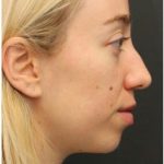 Aesthetic Facial Balancing Before & After Patient #1152