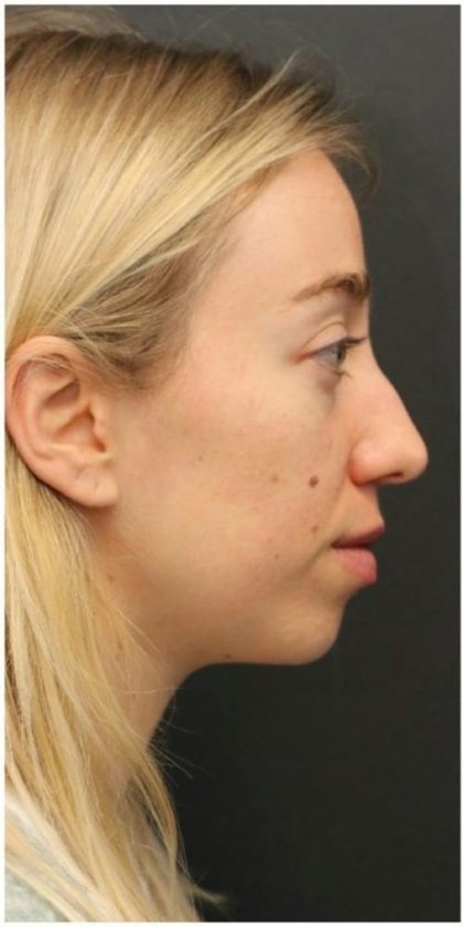 Aesthetic Facial Balancing Before & After Patient #1152