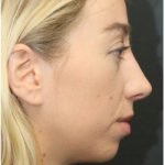 Aesthetic Facial Balancing Before & After Patient #1152
