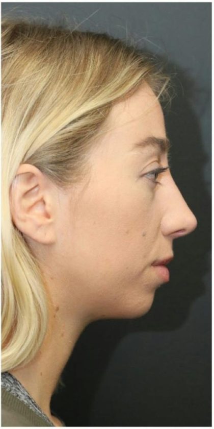 Aesthetic Facial Balancing Before & After Patient #1152