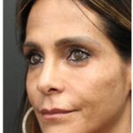 Aesthetic Facial Balancing Before & After Patient #1151