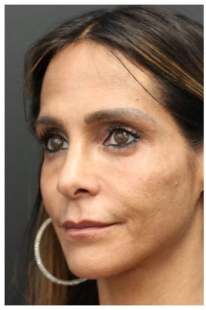 Aesthetic Facial Balancing Before & After Patient #1151