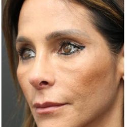 Aesthetic Facial Balancing Before & After Patient #1151