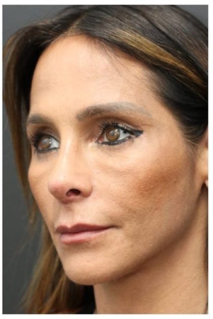 Aesthetic Facial Balancing Before & After Patient #1151