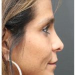 Aesthetic Facial Balancing Before & After Patient #1151