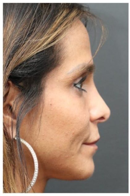 Aesthetic Facial Balancing Before & After Patient #1151