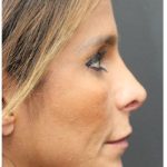 Aesthetic Facial Balancing Before & After Patient #1151