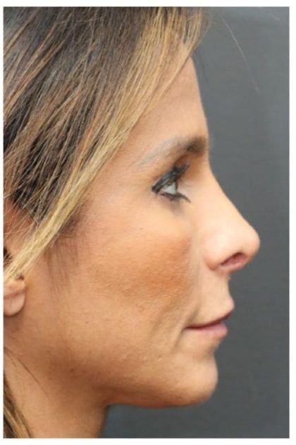 Aesthetic Facial Balancing Before & After Patient #1151