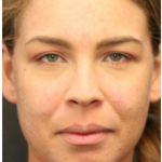 Aesthetic Facial Balancing Before & After Patient #1150