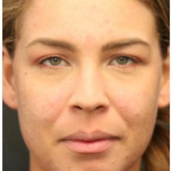 Aesthetic Facial Balancing Before & After Patient #1150