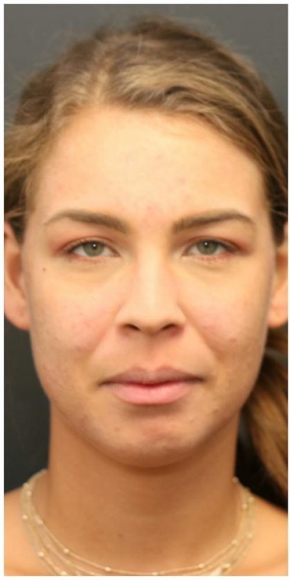 Aesthetic Facial Balancing Before & After Patient #1150