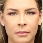 Aesthetic Facial Balancing Before & After Patient #1150