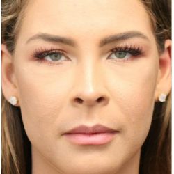 Aesthetic Facial Balancing Before & After Patient #1150