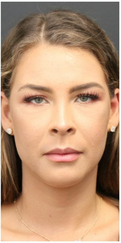 Aesthetic Facial Balancing Before & After Patient #1150