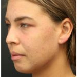 Aesthetic Facial Balancing Before & After Patient #1150