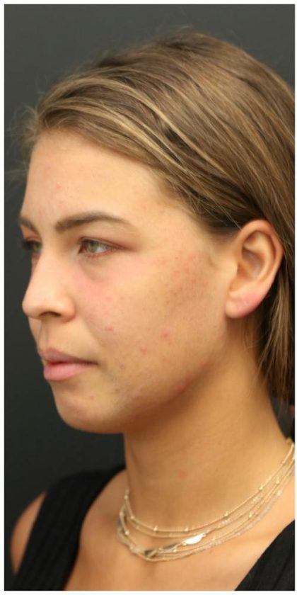 Aesthetic Facial Balancing Before & After Patient #1150