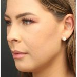 Aesthetic Facial Balancing Before & After Patient #1150