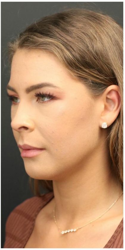 Aesthetic Facial Balancing Before & After Patient #1150