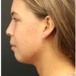 Aesthetic Facial Balancing Before & After Patient #1150