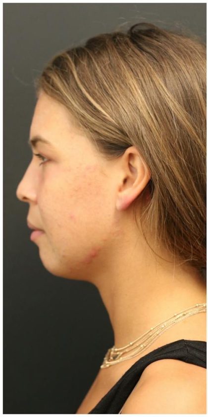 Aesthetic Facial Balancing Before & After Patient #1150