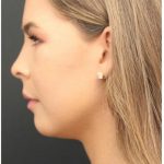 Aesthetic Facial Balancing Before & After Patient #1150