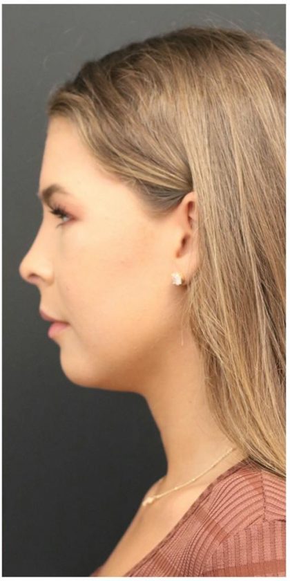 Aesthetic Facial Balancing Before & After Patient #1150