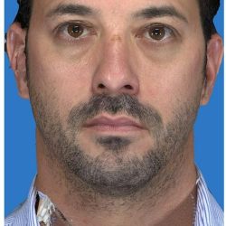 Aesthetic Facial Balancing Before & After Patient #1149