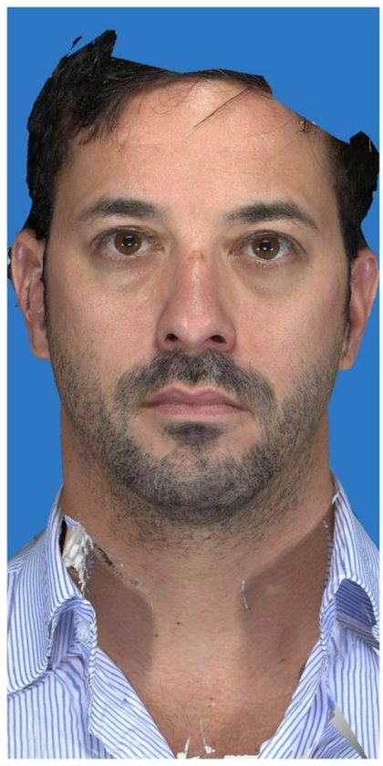 Aesthetic Facial Balancing Before & After Patient #1149