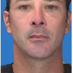 Aesthetic Facial Balancing Before & After Patient #1149