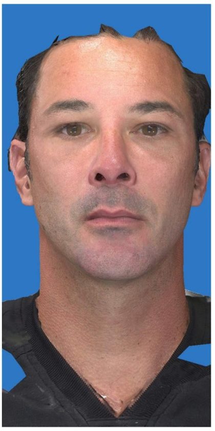Aesthetic Facial Balancing Before & After Patient #1149