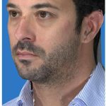 Aesthetic Facial Balancing Before & After Patient #1149