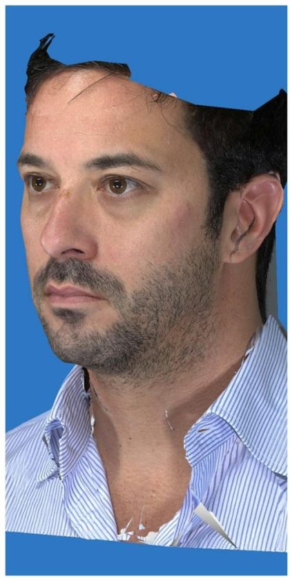 Aesthetic Facial Balancing Before & After Patient #1149