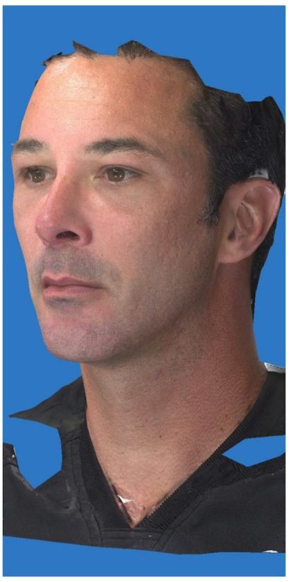 Aesthetic Facial Balancing Before & After Patient #1149
