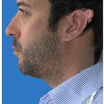 Aesthetic Facial Balancing Before & After Patient #1149