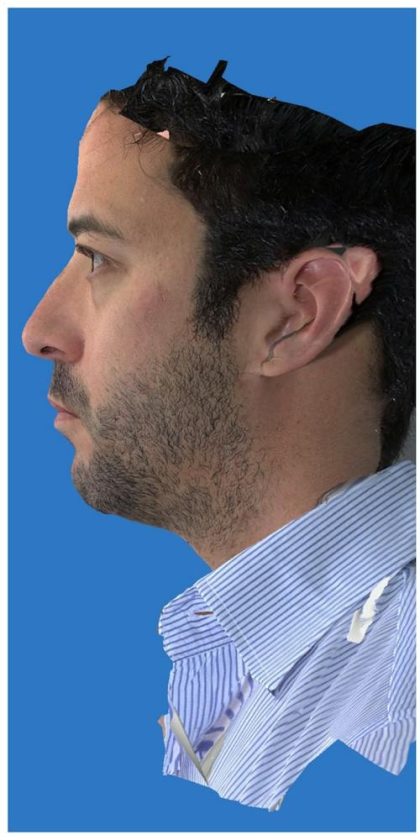 Aesthetic Facial Balancing Before & After Patient #1149