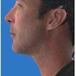 Aesthetic Facial Balancing Before & After Patient #1149