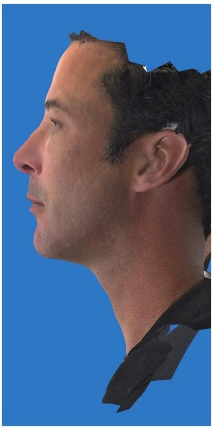 Aesthetic Facial Balancing Before & After Patient #1149