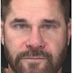 Aesthetic Facial Balancing Before & After Patient #1148
