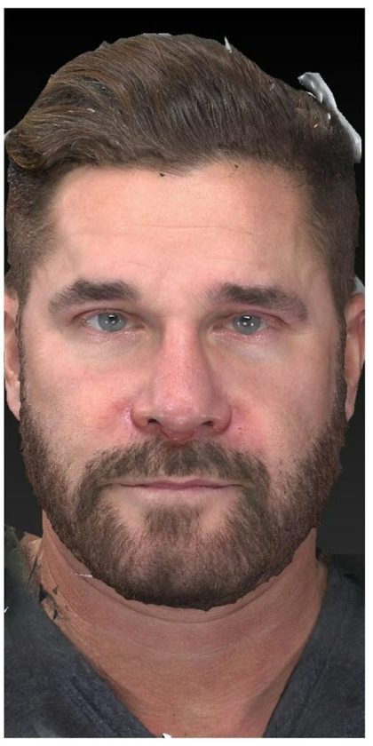 Aesthetic Facial Balancing Before & After Patient #1148