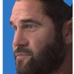 Aesthetic Facial Balancing Before & After Patient #1148