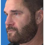 Aesthetic Facial Balancing Before & After Patient #1148
