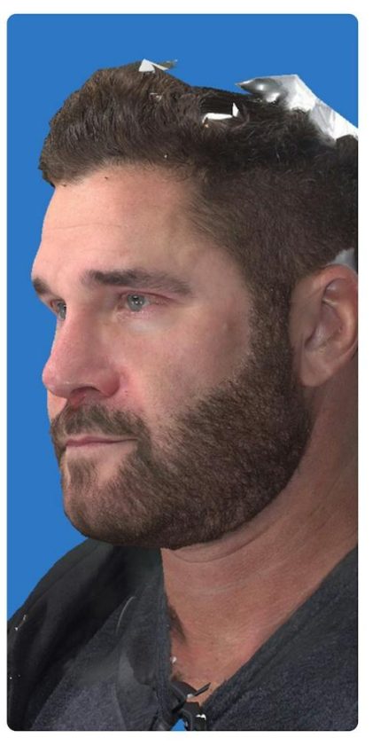 Aesthetic Facial Balancing Before & After Patient #1148