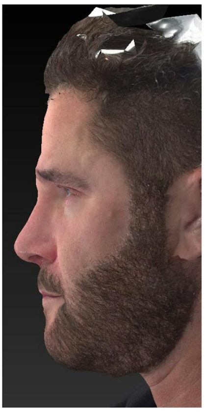 Aesthetic Facial Balancing Before & After Patient #1148